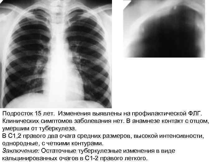 Подросток 15 лет. Изменения выявлены на профилактической ФЛГ. Клинических симптомов заболевания нет. В анамнезе