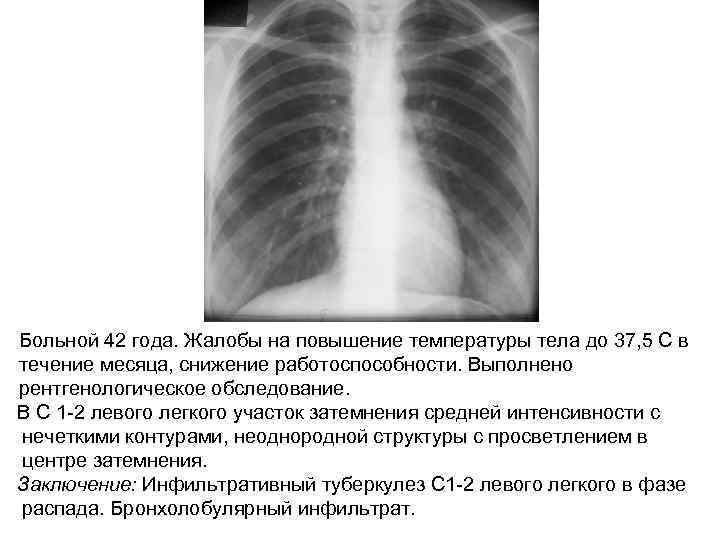 Больной 42 года. Жалобы на повышение температуры тела до 37, 5 С в течение