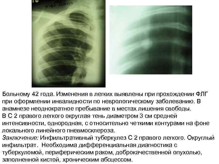 Больному 42 года. Изменения в легких выявлены при прохождении ФЛГ при оформлении инвалидности по