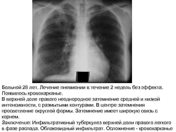 Больной 28 лет. Лечение пневмонии в течение 2 недель без эффекта. Появилось кровохарканье. В