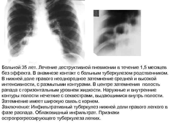 Больной 35 лет. Лечение деструктивной пневмонии в течение 1, 5 месяцев без эффекта. В