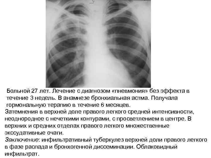 Больной 27 лет. Лечение с диагнозом «пневмония» без эффекта в течение 3 недель. В