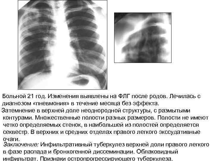 Больной 21 год. Изменения выявлены на ФЛГ после родов. Лечилась с диагнозом «пневмония» в