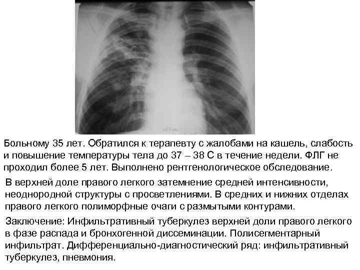 Больному 35 лет. Обратился к терапевту с жалобами на кашель, слабость и повышение температуры