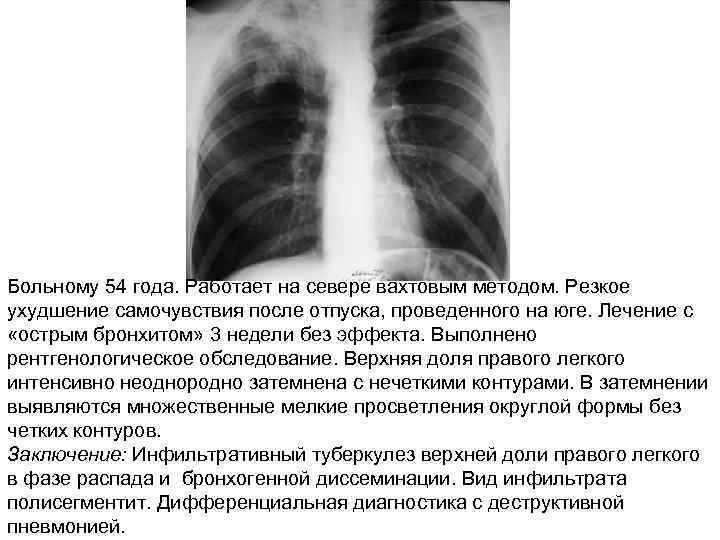 Больному 54 года. Работает на севере вахтовым методом. Резкое ухудшение самочувствия после отпуска, проведенного