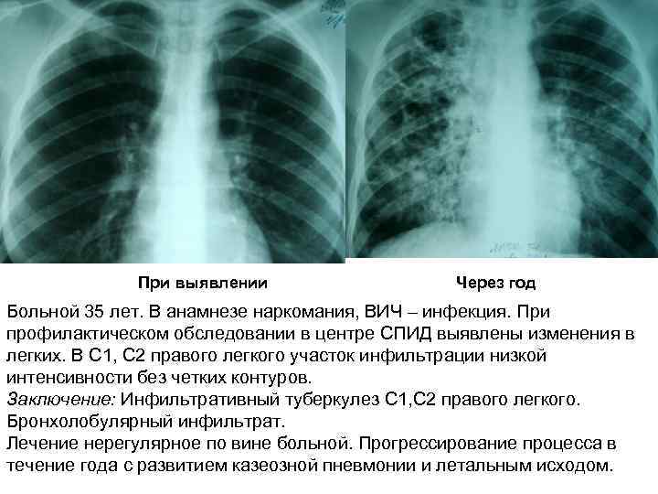 При выявлении Через год Больной 35 лет. В анамнезе наркомания, ВИЧ – инфекция. При