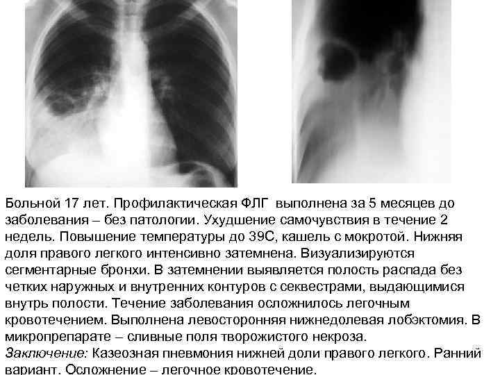 Больной 17 лет. Профилактическая ФЛГ выполнена за 5 месяцев до заболевания – без патологии.