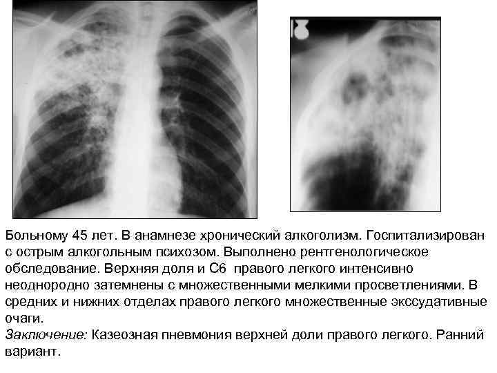 Больному 45 лет. В анамнезе хронический алкоголизм. Госпитализирован с острым алкогольным психозом. Выполнено рентгенологическое