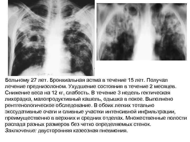 Больному 27 лет. Бронхиальная астма в течение 15 лет. Получал лечение преднизолоном. Ухудшение состояния