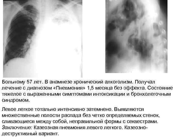 Больному 57 лет. В анамнезе хронический алкоголизм. Получал лечение с диагнозом «Пневмония» 1, 5