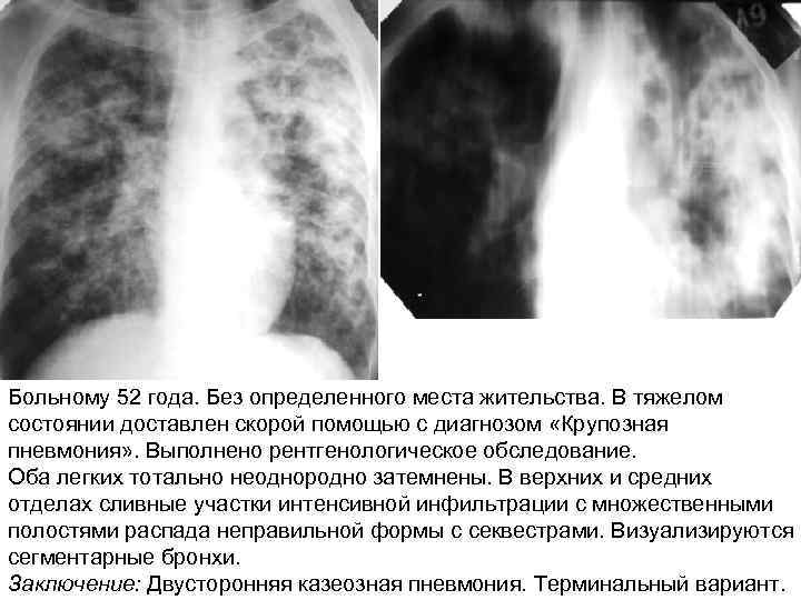 Больному 52 года. Без определенного места жительства. В тяжелом состоянии доставлен скорой помощью с