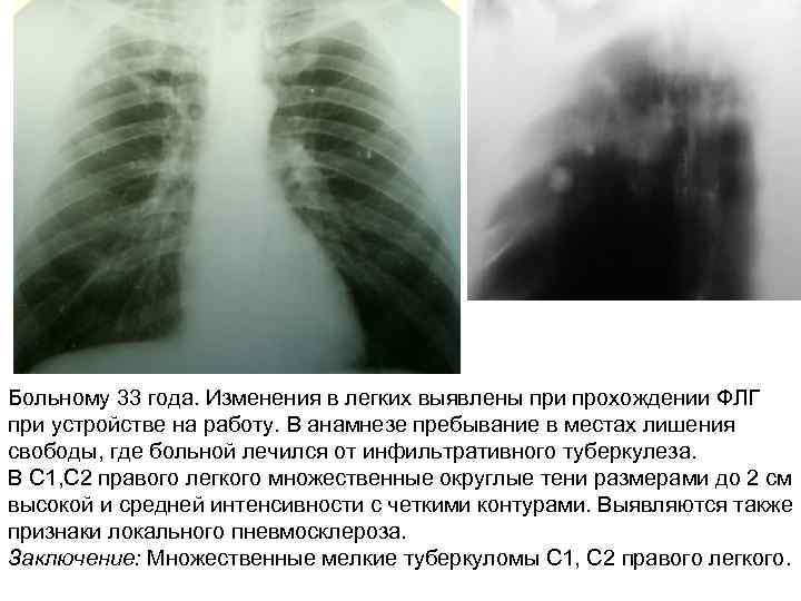 Больному 33 года. Изменения в легких выявлены при прохождении ФЛГ при устройстве на работу.