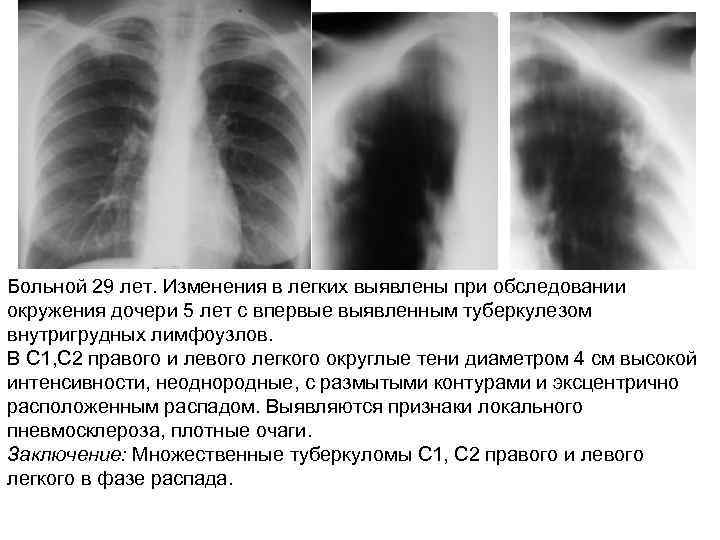 Больной 29 лет. Изменения в легких выявлены при обследовании окружения дочери 5 лет с