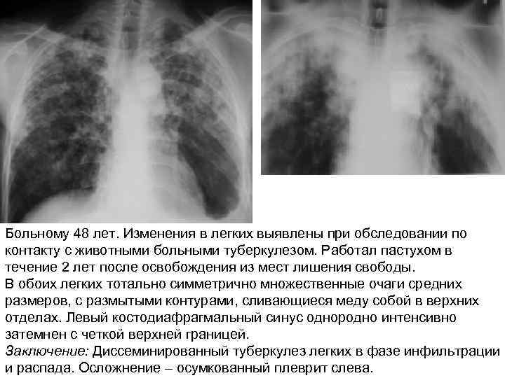 Больному 48 лет. Изменения в легких выявлены при обследовании по контакту с животными больными