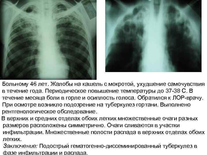 Больному 46 лет. Жалобы на кашель с мокротой, ухудшение самочувствия в течение года. Периодическое