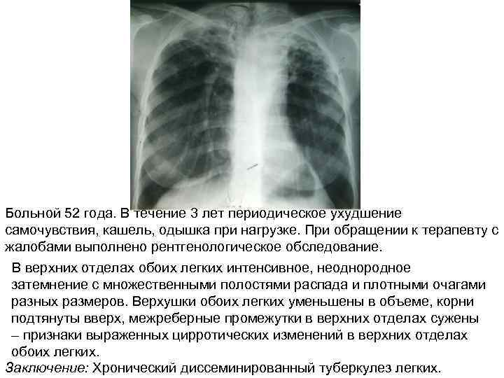 Больной 52 года. В течение 3 лет периодическое ухудшение самочувствия, кашель, одышка при нагрузке.