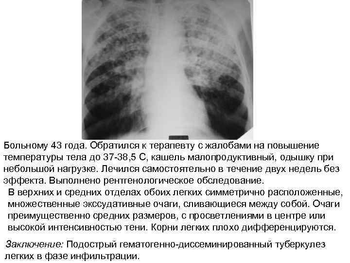 Больному 43 года. Обратился к терапевту с жалобами на повышение температуры тела до 37