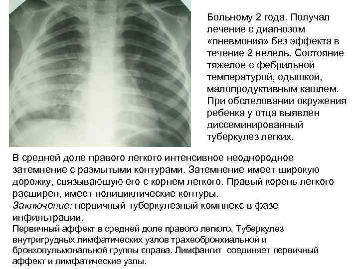 Больному 2 года. Получал лечение с диагнозом «пневмония» без эффекта в течение 2 недель.