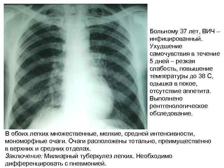 Больному 37 лет, ВИЧ – инфицированный. Ухудшение самочувствия в течение 5 дней – резкая