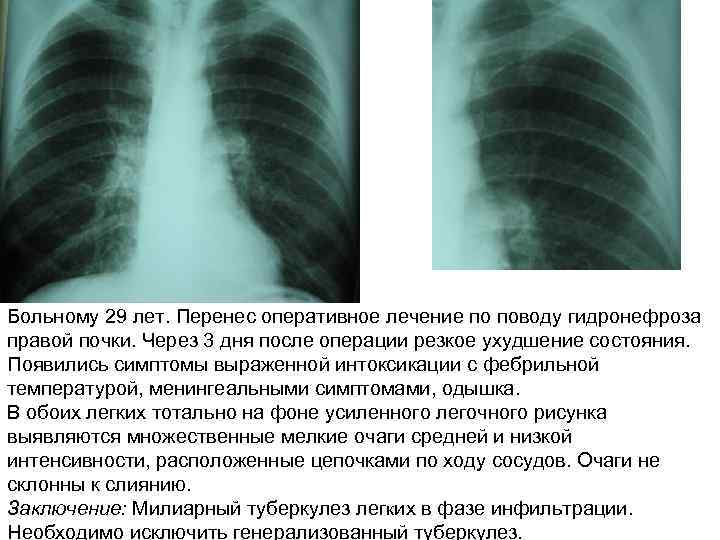 Больному 29 лет. Перенес оперативное лечение по поводу гидронефроза правой почки. Через 3 дня