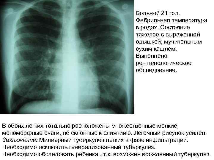 Больной 21 год. Фебрильная температура в родах. Состояние тяжелое с выраженной одышкой, мучительным сухим