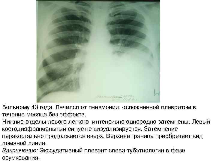 Больному 43 года. Лечился от пневмонии, осложненной плевритом в течение месяца без эффекта. Нижние