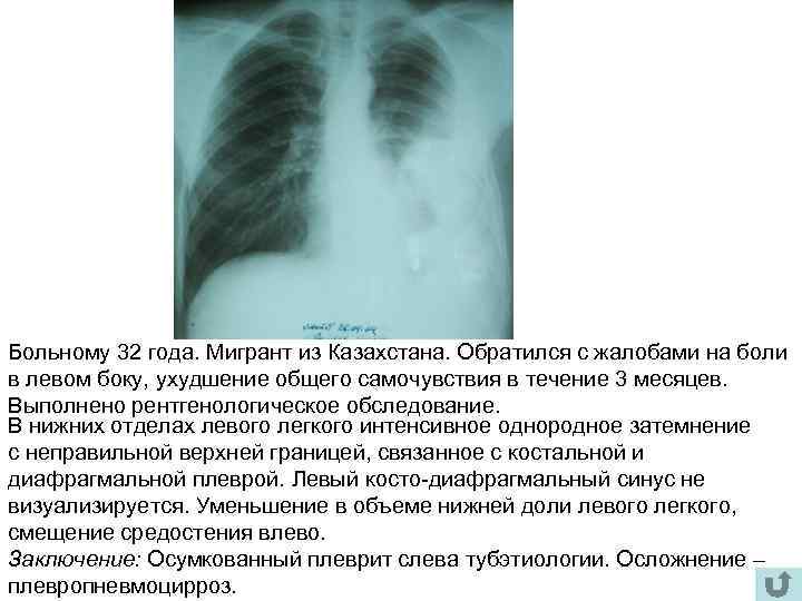 Больному 32 года. Мигрант из Казахстана. Обратился с жалобами на боли в левом боку,