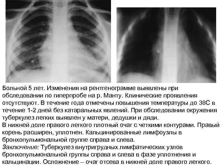 Больной 5 лет. Изменения на рентгенограмме выявлены при обследовании по гиперпробе на р. Манту.