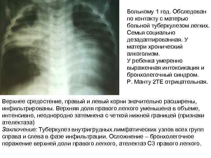 Больному 1 год. Обследован по контакту с матерью больной туберкулезом легких. Семья социально дезадаптированная.