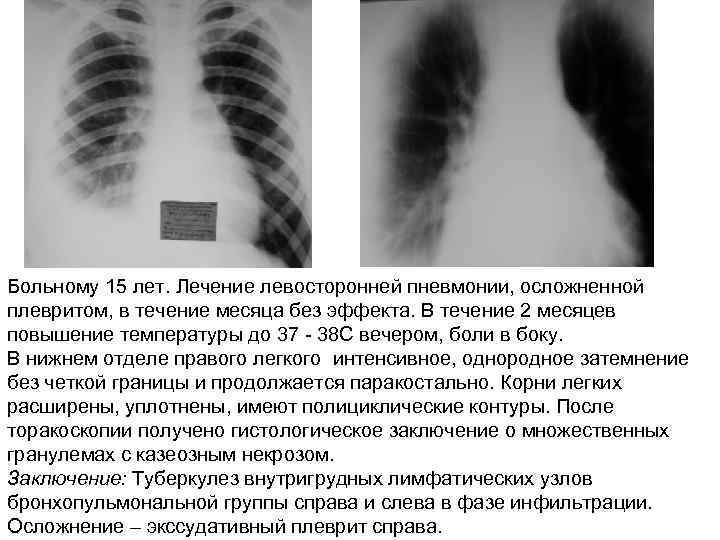 Больному 15 лет. Лечение левосторонней пневмонии, осложненной плевритом, в течение месяца без эффекта. В