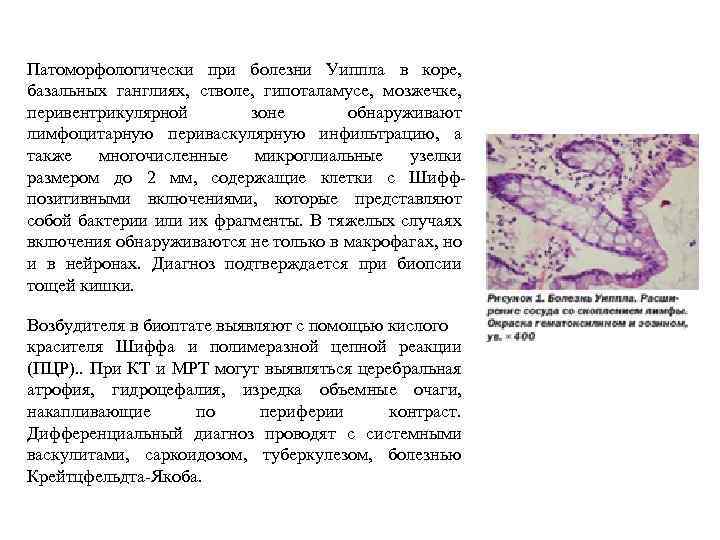 Патоморфологически при болезни Уиппла в коре, базальных ганглиях, стволе, гипоталамусе, мозжечке, перивентрикулярной зоне обнаруживают