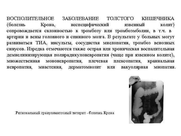 ВОСПОЛИТЕЛЬНОЕ ЗАБОЛЕВАНИЕ ТОЛСТОГО КИШЕЧНИКА (болезнь Крона, неспецифический язвенный колит) сопровождается склонностью к тромбозу или