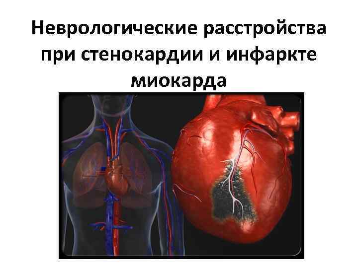 Неврологические расстройства при стенокардии и инфаркте миокарда 