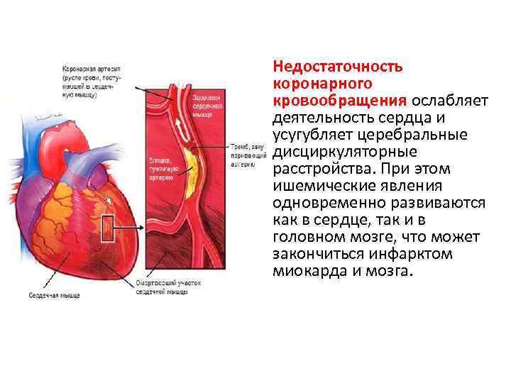 Недостаточность коронарного кровообращения ослабляет деятельность сердца и усугубляет церебральные дисциркуляторные расстройства. При этом ишемические