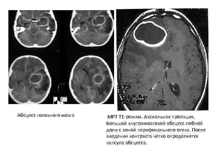 Абсцесс головного мозга МРТ Т 1 -режим. Аксиальная проекция. Большой внутримозговой абсцесс лобной доли