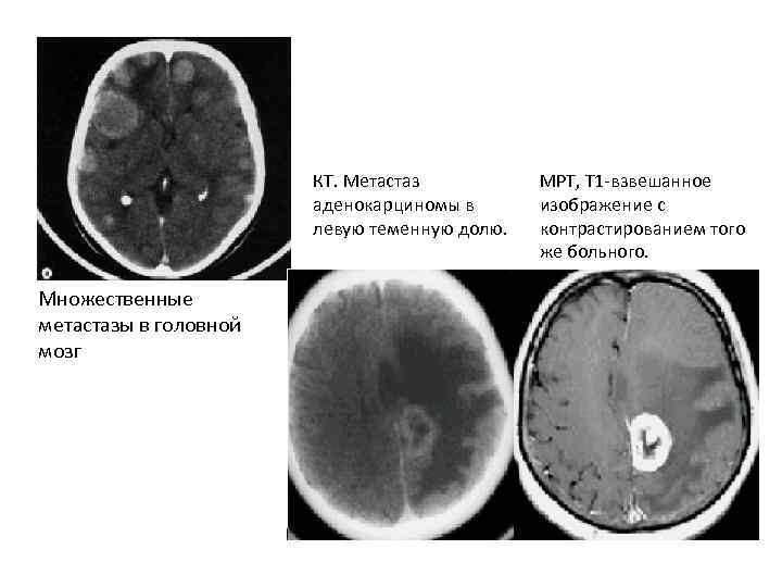 КТ. Метастаз аденокарциномы в левую теменную долю. Множественные метастазы в головной мозг МРТ, Т