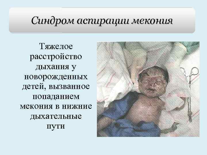 Синдром аспирации мекония Тяжелое расстройство дыхания у новорожденных детей, вызванное попаданием мекония в нижние