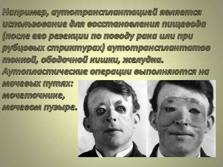 Например, аутотрансплантацией является использование для восстановления пищевода (после его резекции по поводу рака или