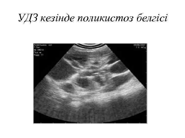 УДЗ кезінде поликистоз белгісі 