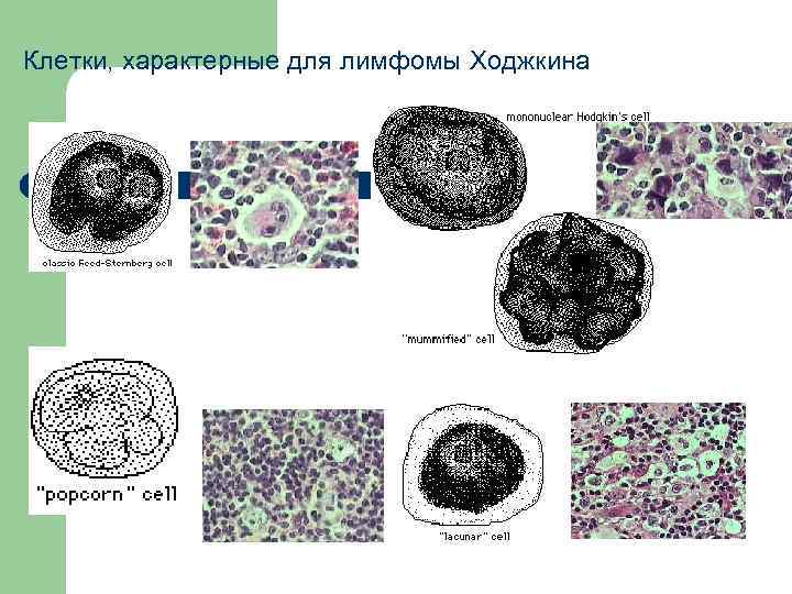 Для клеток характерны. Клетки при лимфоме Ходжкина. Лакунарные клетки лимфома Ходжкина. Ходжкинские лимфомы клетки. Клетки которые встречаются при лимфоме Ходжкина.