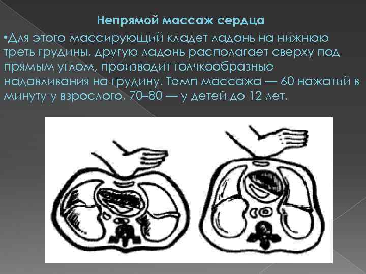 Непрямой массаж сердца • Для этого массирующий кладет ладонь на нижнюю треть грудины, другую