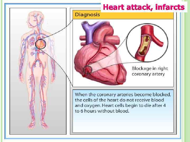Heart attack, infarcts 