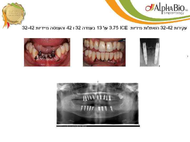  עקירות 24 -23 השתלות מידיות 3. 75 ICE על 31 בעמדה 23 ו
