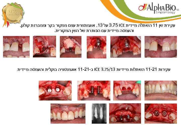  עקירת שן 11 השתלה מיידית 3. 75 ICE על 31, אוגמנטצית עצם ממקור