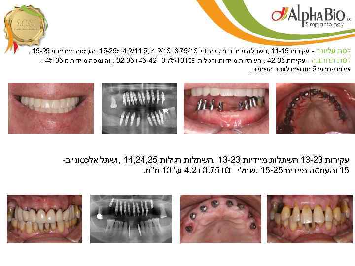  לסת עליונה - עקירות 51 -11 , השתלה מיידית ורגילה 4. 2/11. 5,