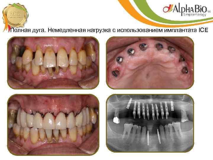 Полная дуга. Немедленная нагрузка с использованием имплантата ICE 
