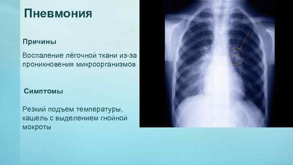 Пневмония Причины Воспаление лёгочной ткани из-за проникновения микроорганизмов Симптомы Резкий подъем температуры, кашель с