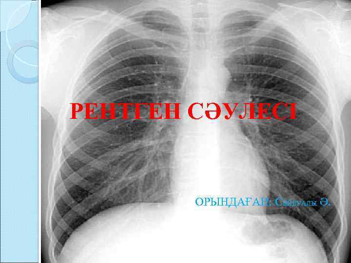 РЕНТГЕН СӘУЛЕСІ ОРЫНДАҒАН: СЕЙДУАЛЫ Ә. 