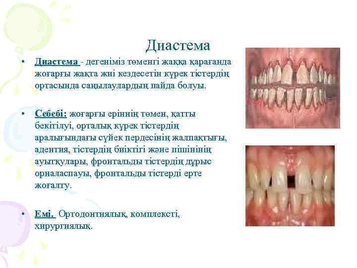 Диастема • Диастема - дегеніміз төменгі жаққа қарағанда жоғарғы жақта жиі кездесетін күрек тістердің