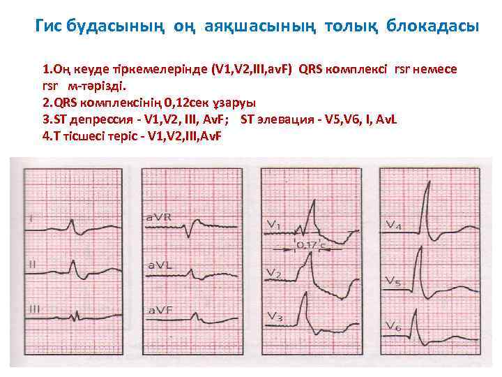 Гис будасының оң аяқшасының толық блокадасы 1. Оң кеуде тіркемелерінде (V 1, V 2,
